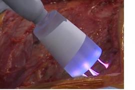 a beam of energized plasma kills cancer cells