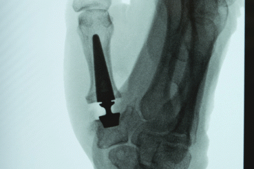 Modular 3-part thumb joint replacement 