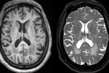 ARTS: neuroimaging measure of cerebral arteriosclerosis