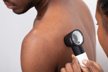 A Black dermatologist examines a Black man's back for signs of skin cancer with a dermatoscope. 