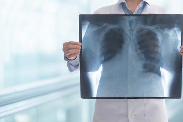 X-ray image of lungs