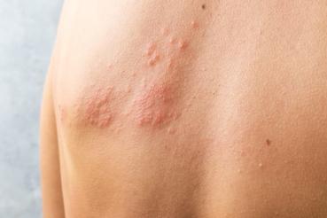 An image of shingles on a person's back