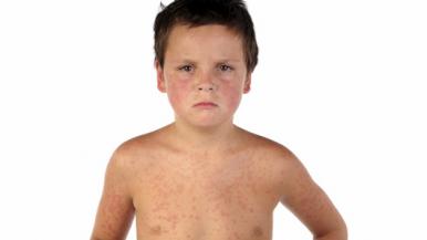 Measles-Vaccination-QA-Feature-Image.jpg