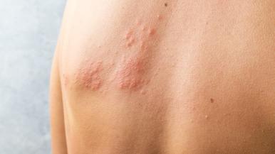 An image of shingles on a person's back