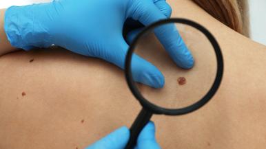 dermatologist checking a mole on skin