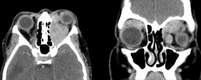 CT orbits with axial and coronal cuts demonstrating bilateral masses, more significant on the left, with marked proptosis and complete encasement of left optic nerve sheath.