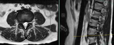 Preoperative MRI showing far lateral and foraminal right L4-5 disc herniation